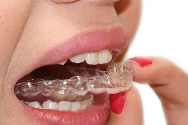 Aligneurs transparents SMILERS – Cabinet KEO Bron