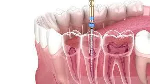 Endodontie sous microscope à Bron et Lyon – Cabinet KEO