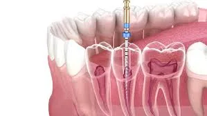 Endodontie sous microscope à Bron et Lyon – Cabinet KEO