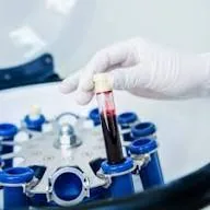 PRF en chirurgie dentaire : votre propre sang au service de la cicatrisation